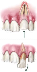 dislodged-tooth-155x300